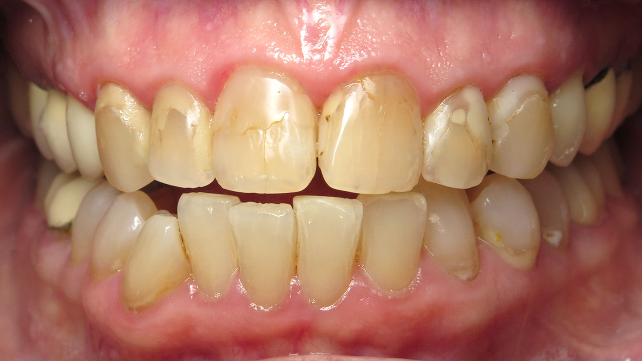 Anterior Crowns Large Fillings Before Retracted Grandville Mi