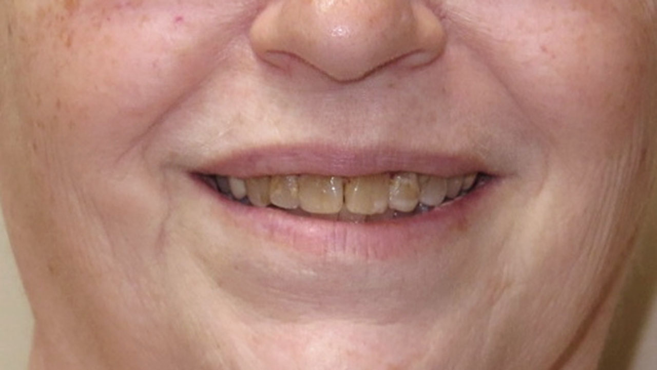 Anterior Crowns Large Fillings Before Smile Grandville Mi
