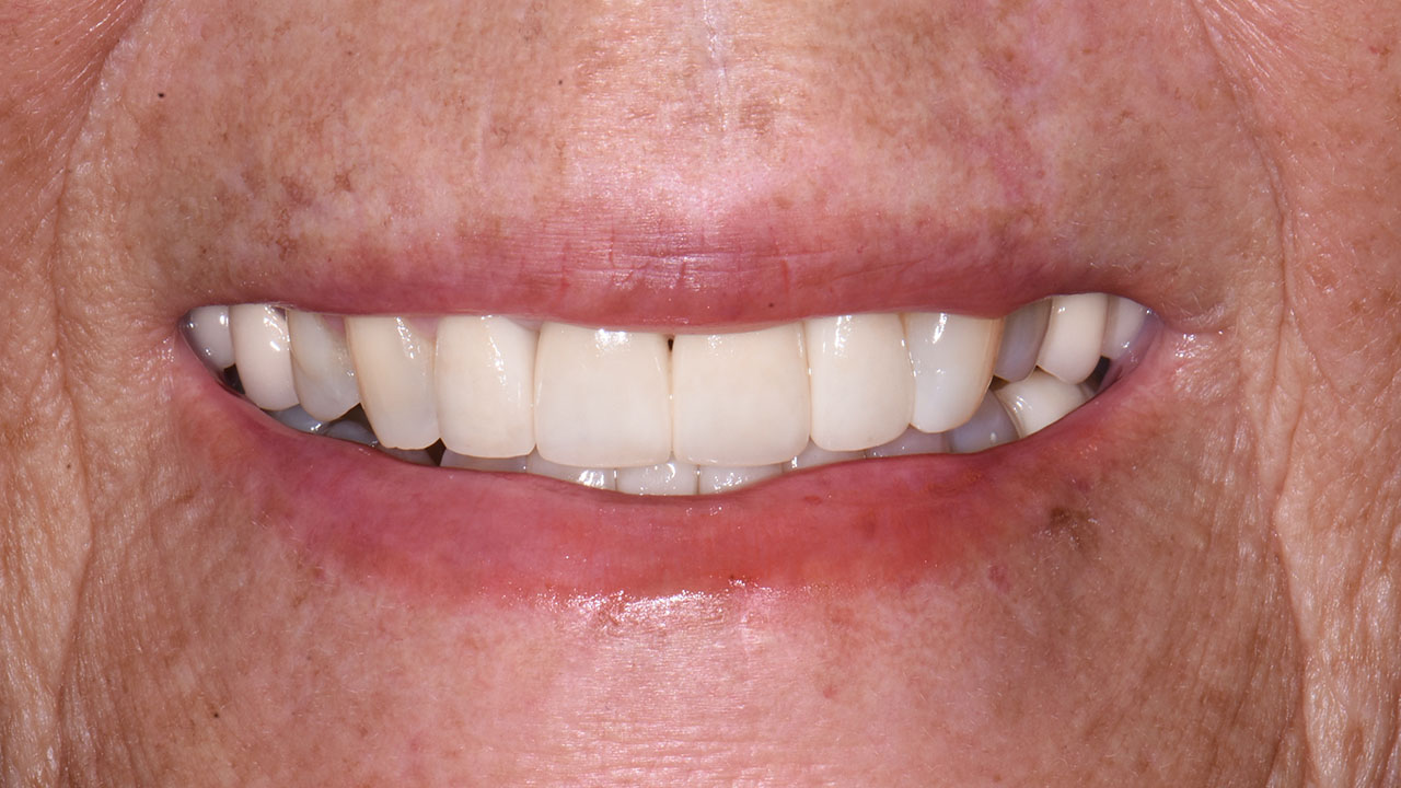Anterior Crowns Metal Margins After Close Smile Grandville Mi