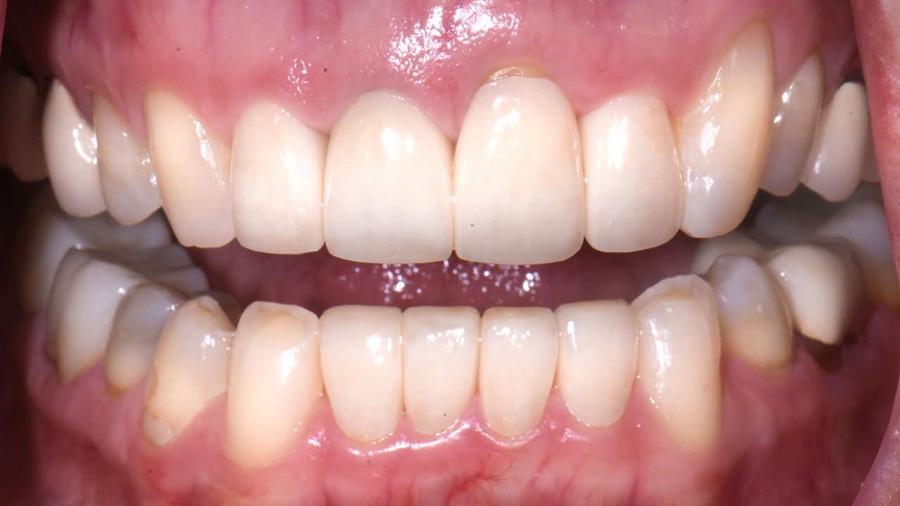 Anterior Crowns Metal Margins After Retracted Grandville Mi