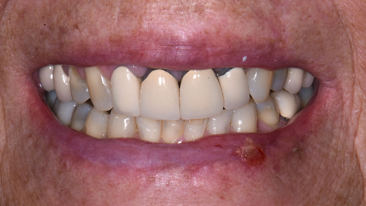 Anterior Crowns Metal Margins Before Close Smile Grandville Mi