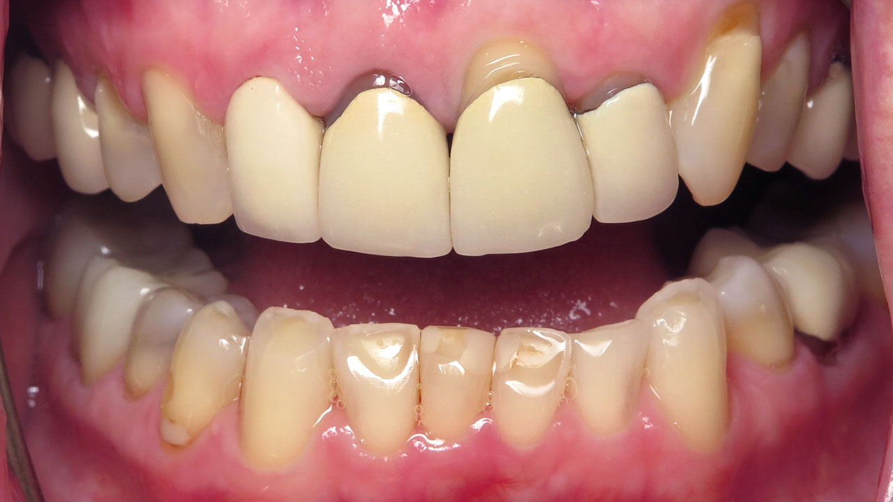 Anterior Crowns Metal Margins Before Retracted Grandville Mi