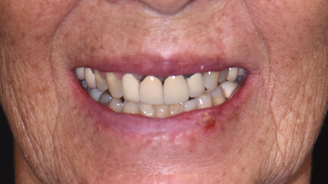 Anterior Crowns Metal Margins Before Smile Grandville Mi