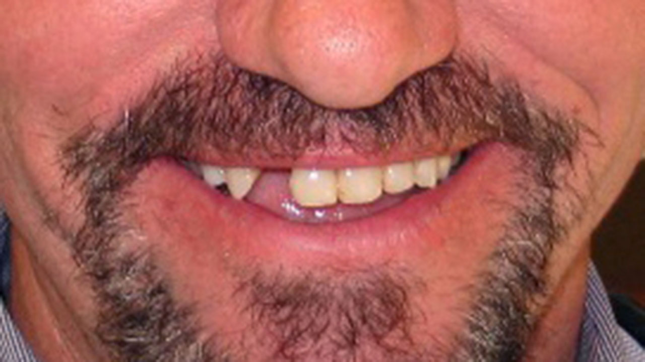 Before Broken Front Tooth Grandville Mi