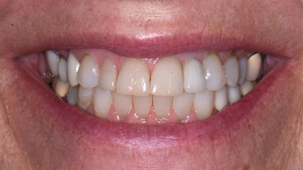 Before Close Up Color Variation Front Teeth Grandville Mi