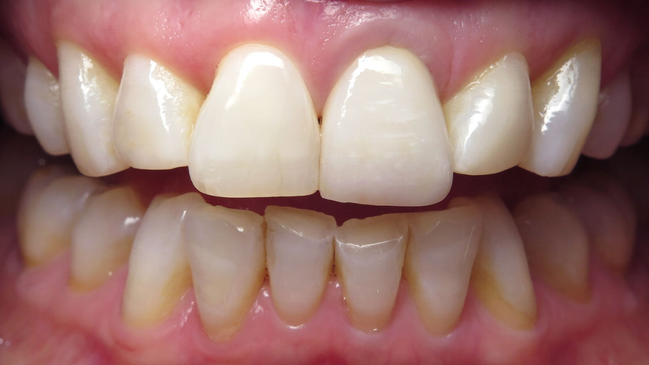 Before Close Up Failing Front Tooth Crown Grandville Mi