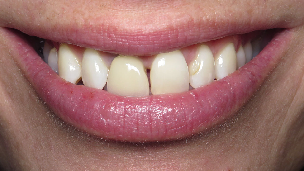 Before Failed Front Tooth Crown Grandville Mi