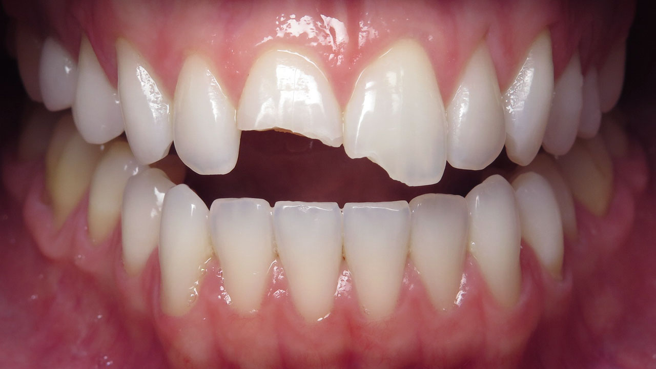 Before Fractured Front Teeth Close View Grandville Mi