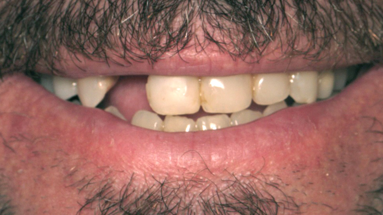 Before Fractured Root Front Tooth Grandville Mi