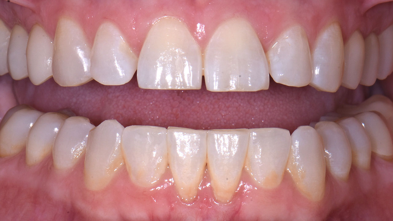 Before Front Teeth Alignment Close View Grandville Mi