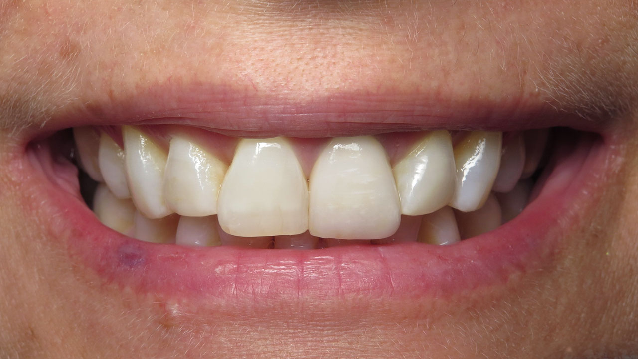 Before Front Tooth Crown Out Of Alignment Grandville Mi