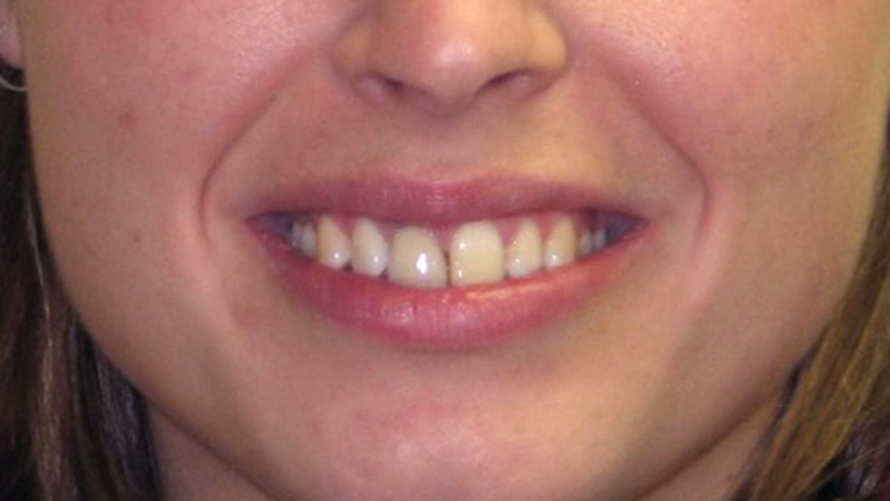 Before Front Tooth Damage Trauma Grandville Mi