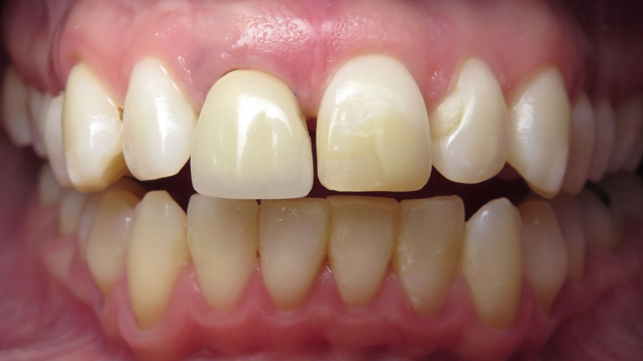 Before Front Tooth Misalignment Grandville Mi