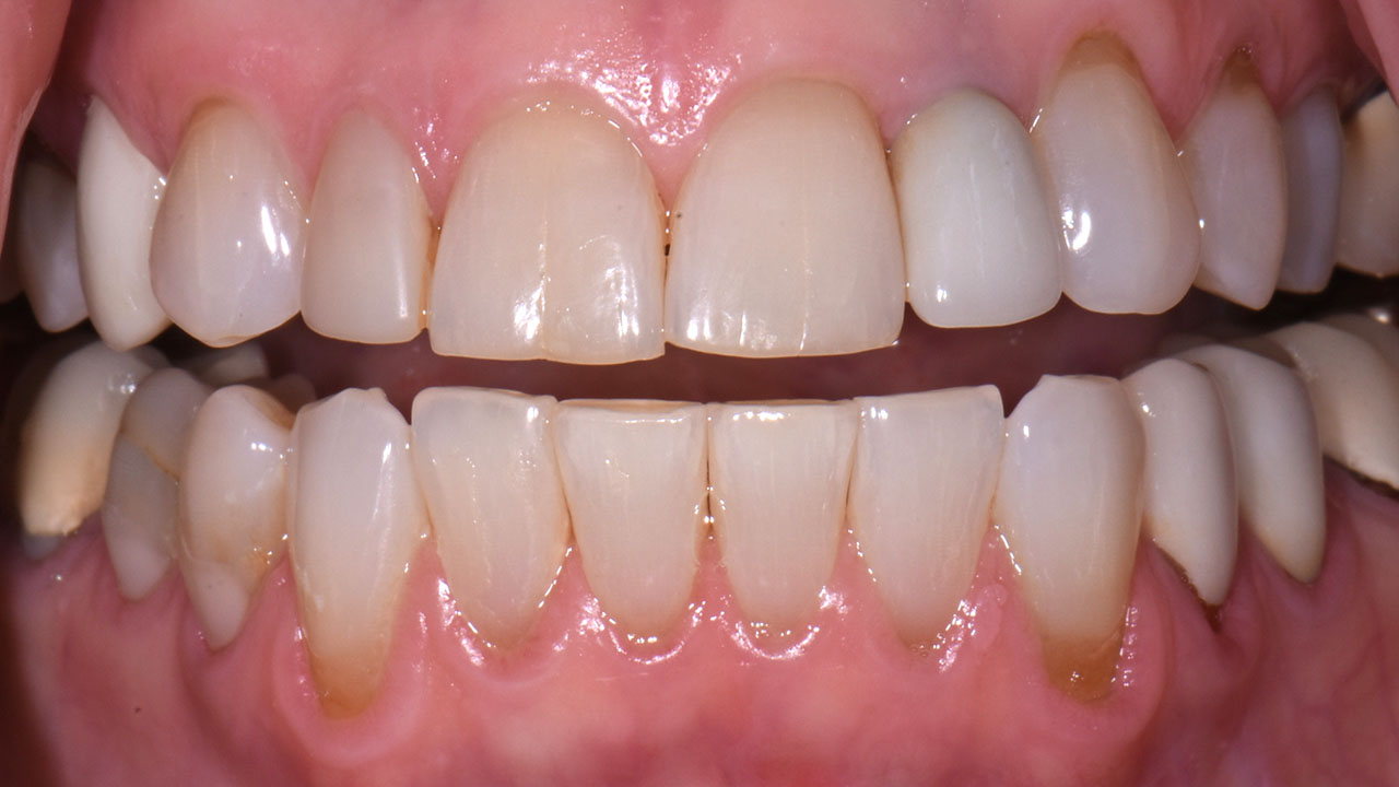 Before Implant Crown Front Tooth Grandville Mi