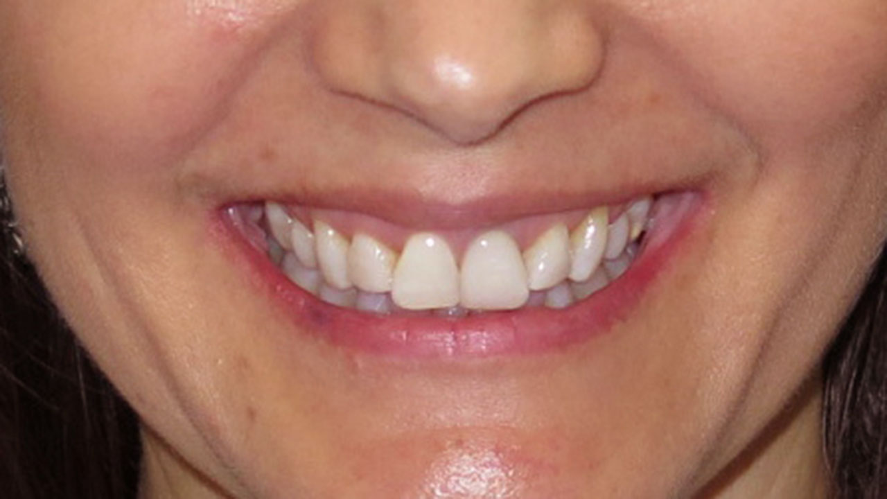 Before Injured Front Tooth Crown Grandville Mi