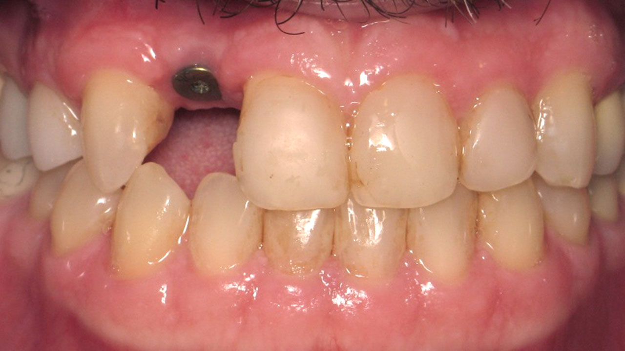 Before Missing Front Tooth After Extraction Grandville Mi