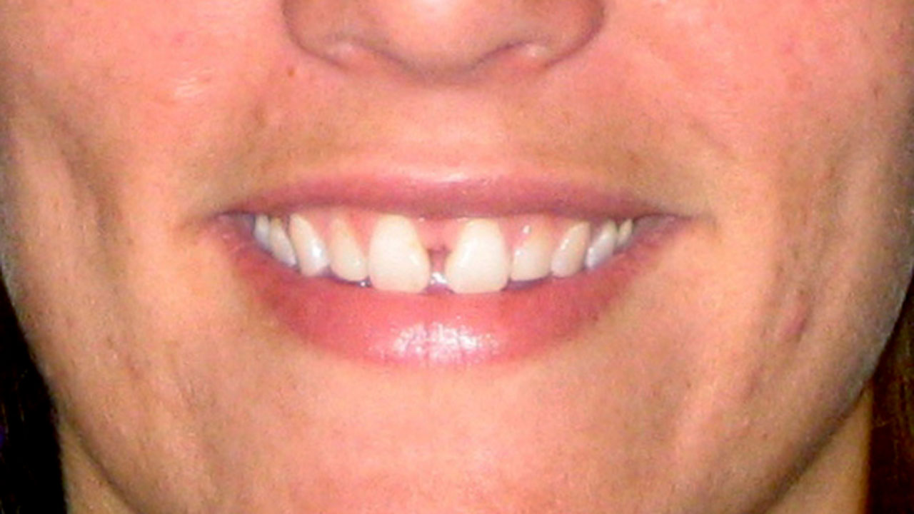 Before Orthodontic Treatment Spacing Front Teeth Grandville Mi