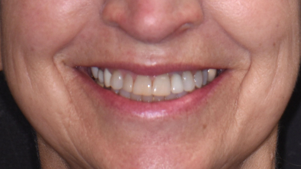 Before Smile Mismatched Dental Work Grandville Mi