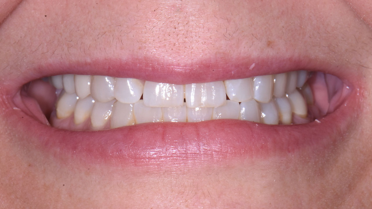 Before Smile Spacing And Tooth Shape Grandville Mi