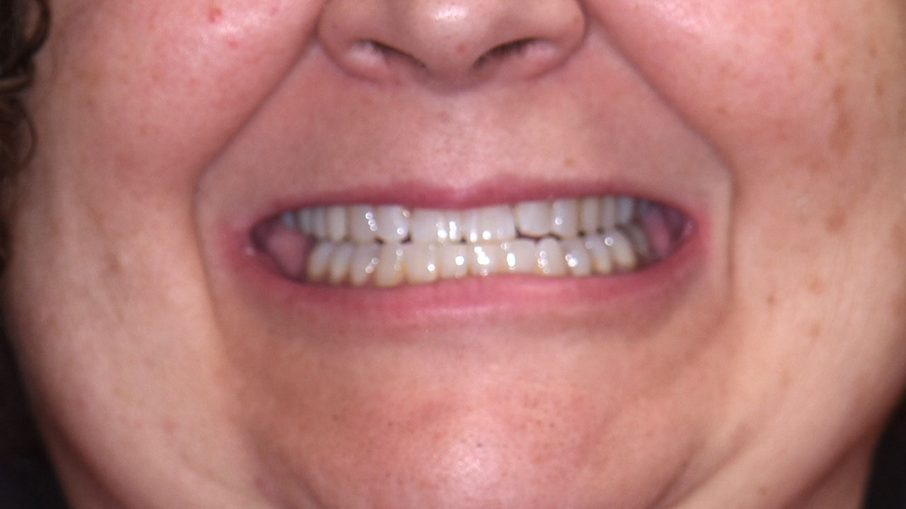 Before Spaced Flared Front Teeth Grandville Mi