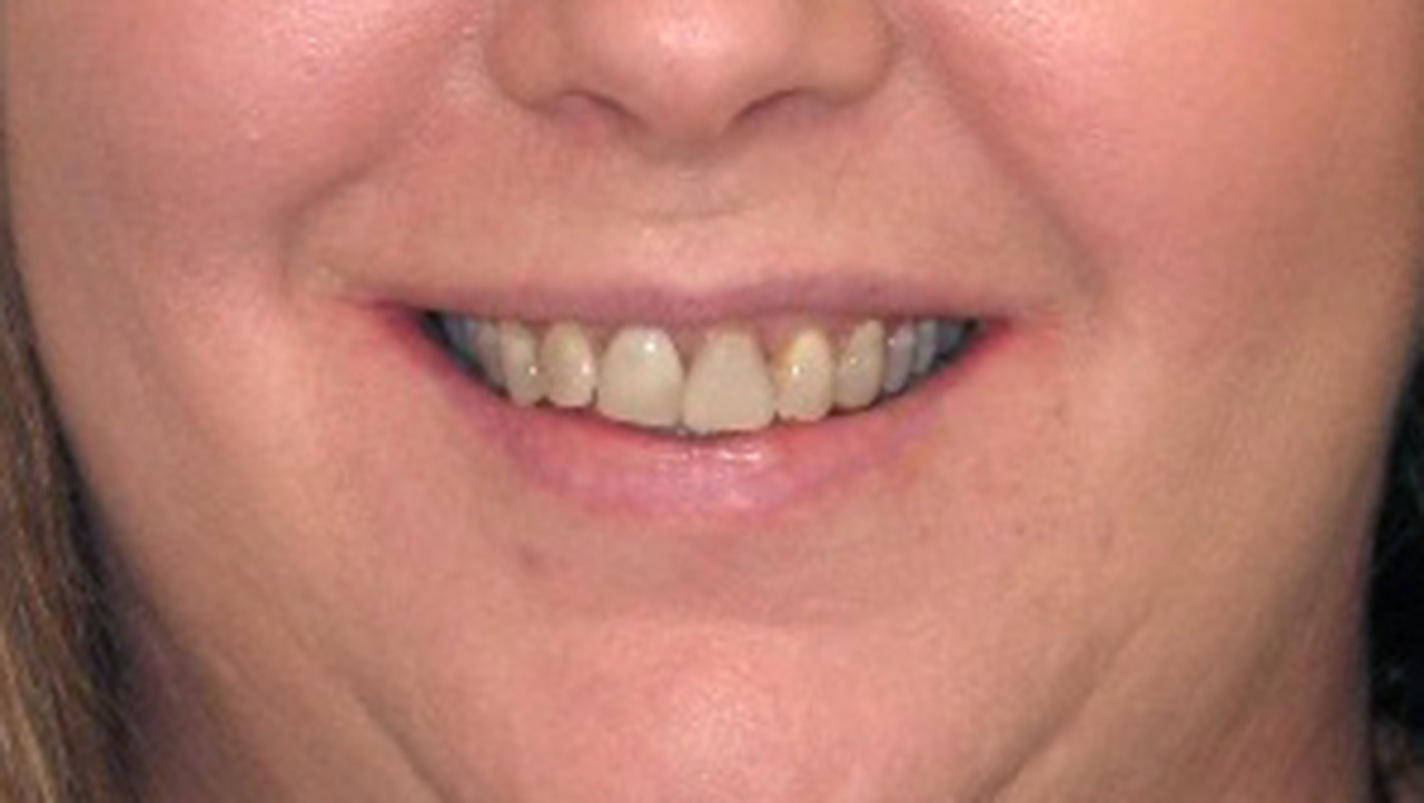 Before Tetracycline Stained Smile Grandville Mi