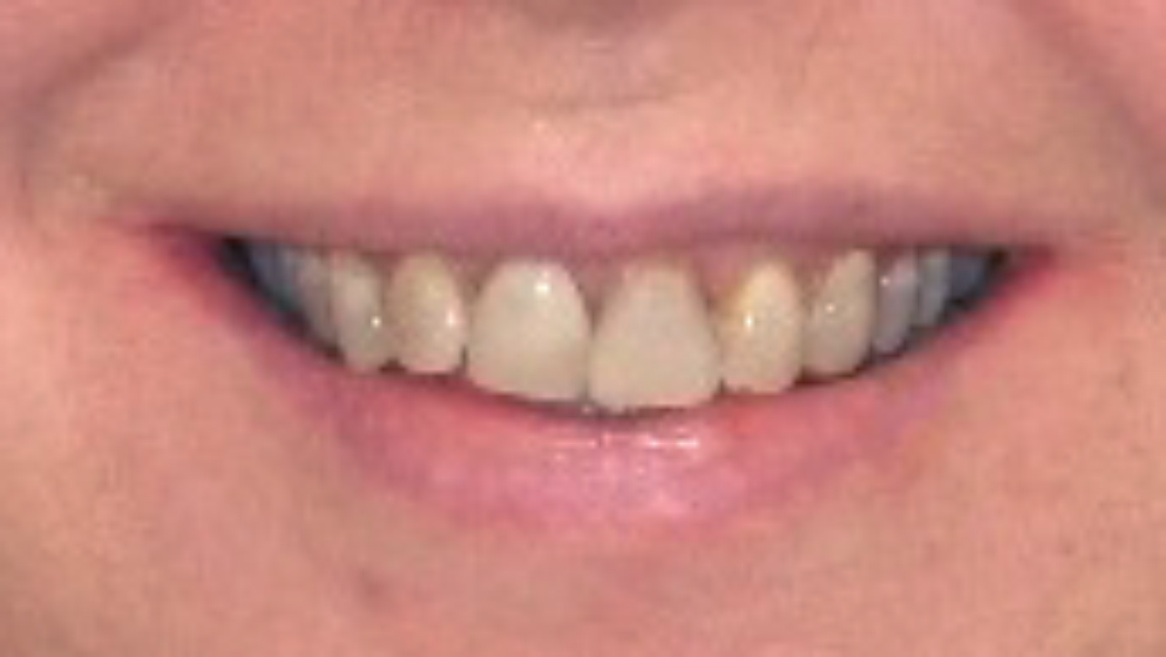 Before Tetracycline Stained Teeth Old Veneers Grandville Mi