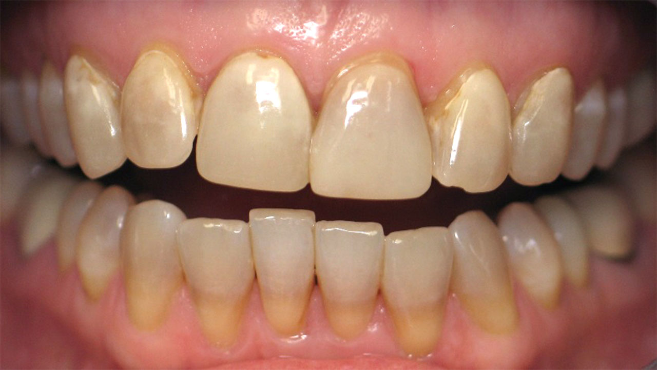 Before Tetracycline Staining Retracted View Grandville Mi