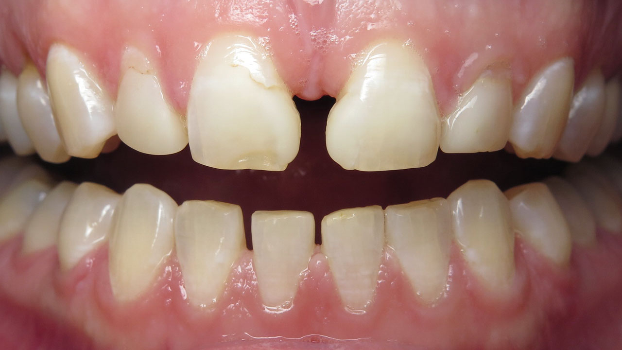 Before Triangular Shaped Teeth Spacing Grandville Mi