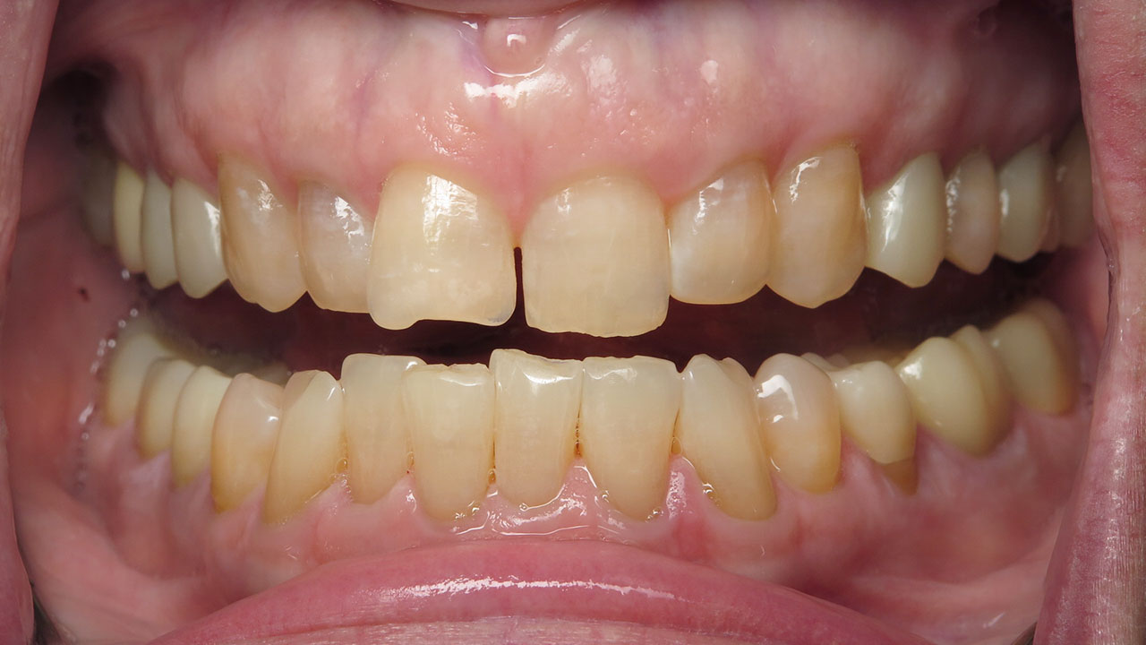 Ceramic Crowns And Composite Fillings Retracted After Grandville Mi