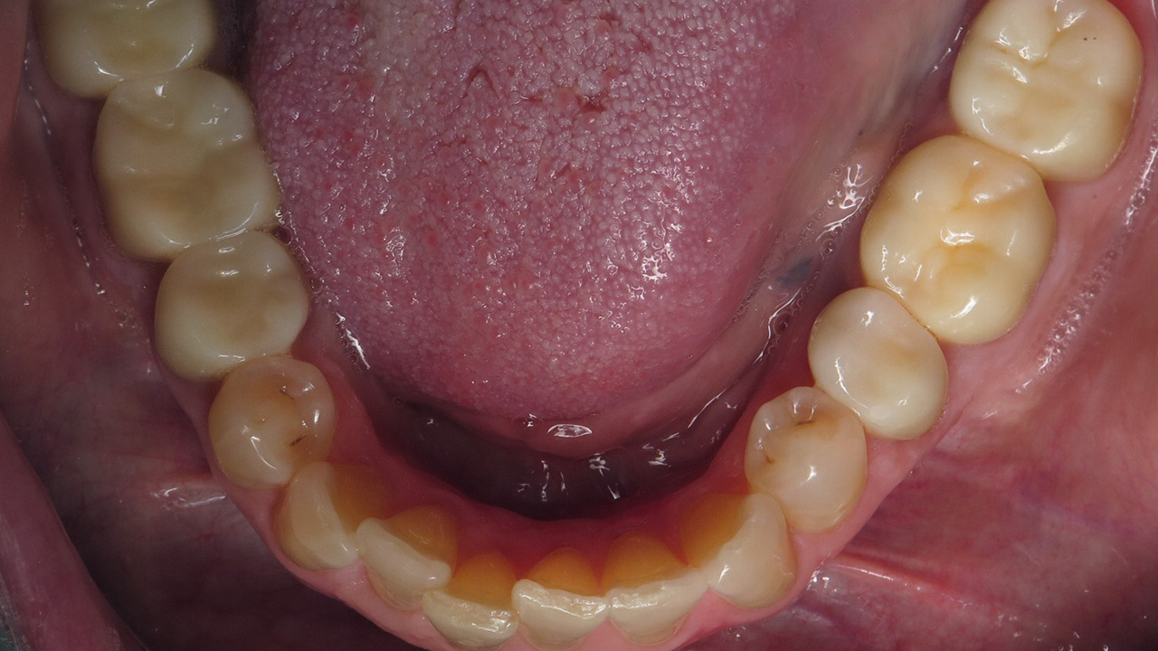 Ceramic Restorations Lower Teeth After Grandville Mi