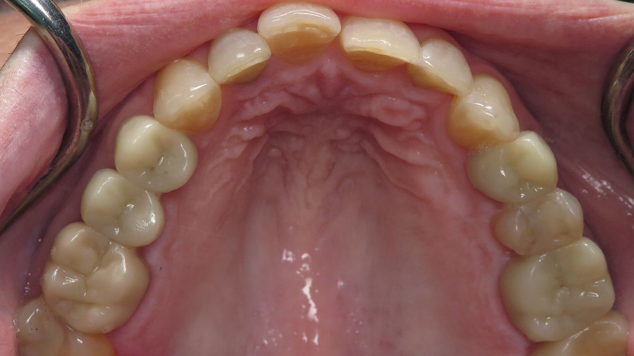 Ceramic Restorations Upper Teeth After Grandville Mi