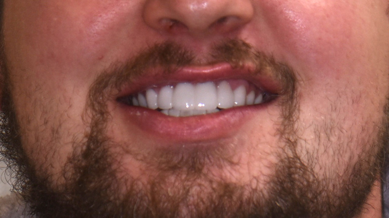 Ceramic Veneers And Bridge Smile Reconstruction After Grandville Mi