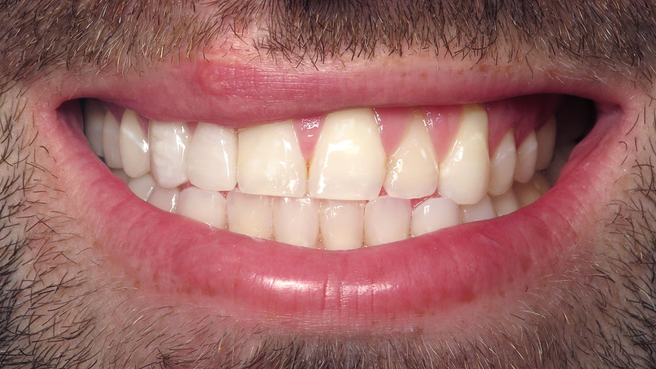 Cleft Lip Palate Cantilever Bridge Close Up After Grandville Mi