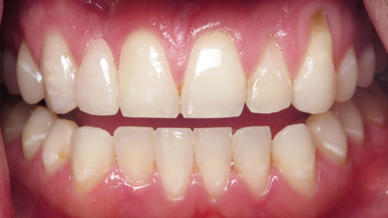 Cleft Lip Palate Cantilever Bridge Retracted After Grandville Mi