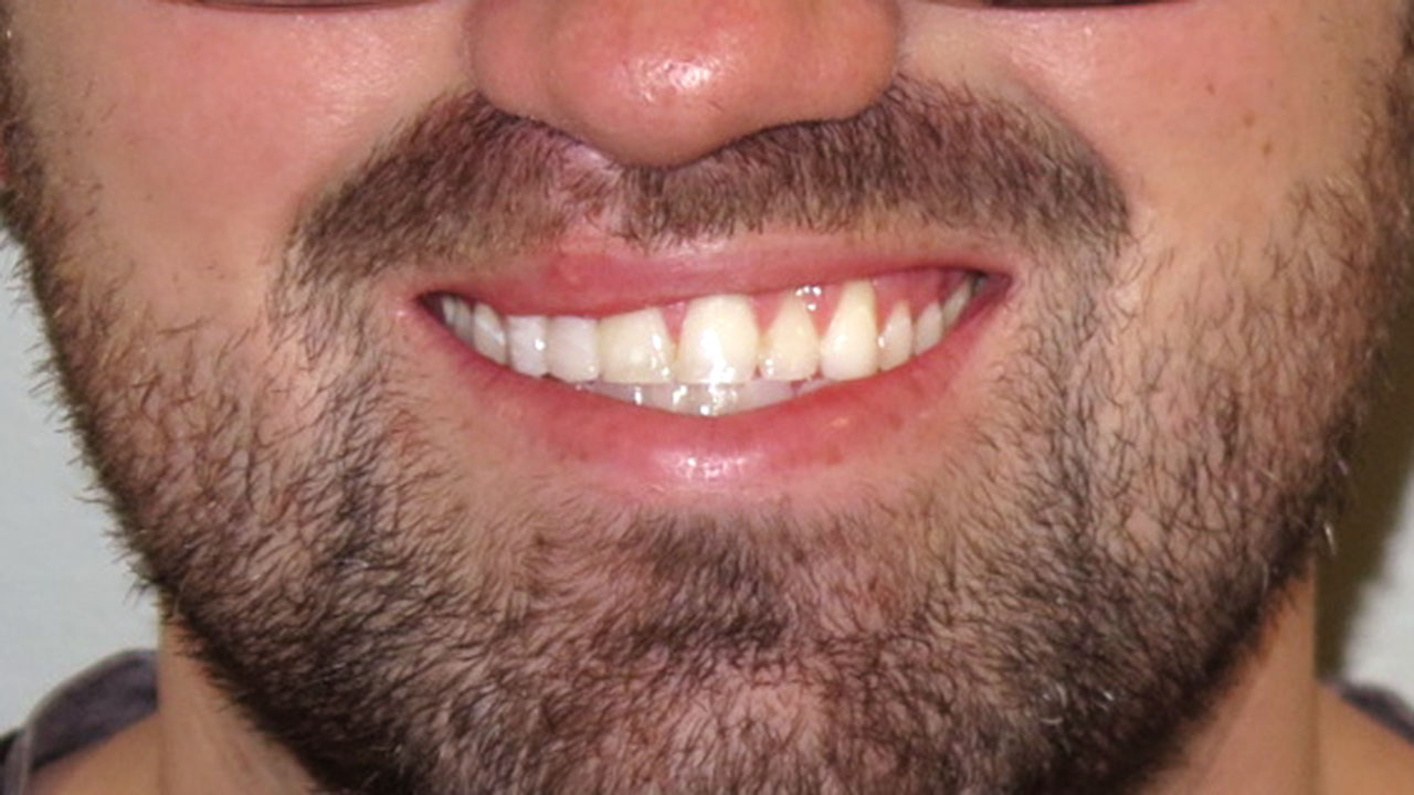 Cleft Lip Palate Cantilever Bridge Smile After Grandville Mi