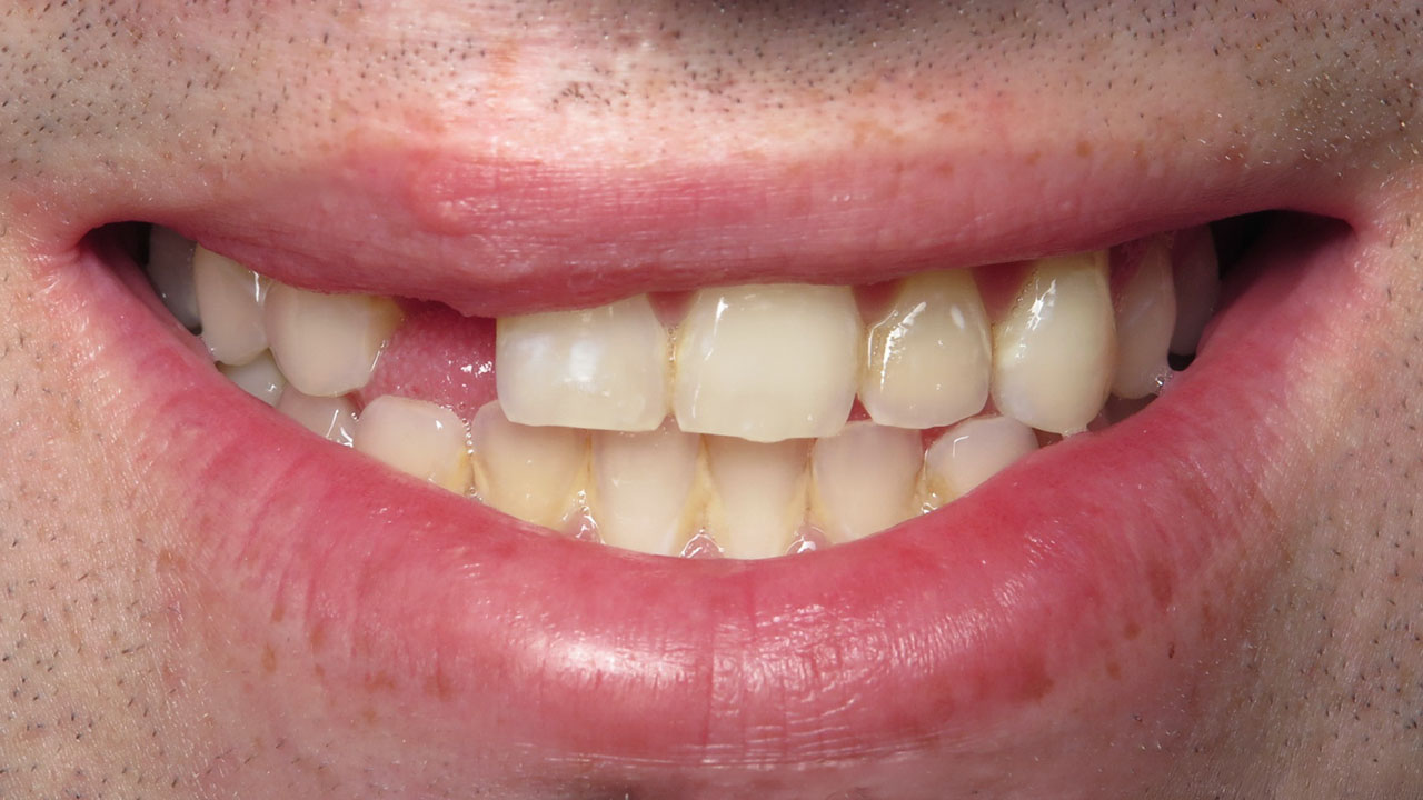 Cleft Lip Palate Missing Tooth Close Up Before Grandville Mi