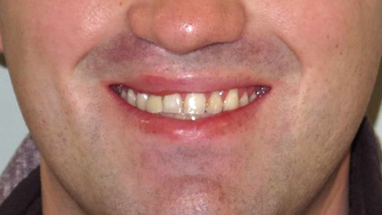 Cleft Lip Palate Missing Tooth Flipper Smile Before Grandville Mi