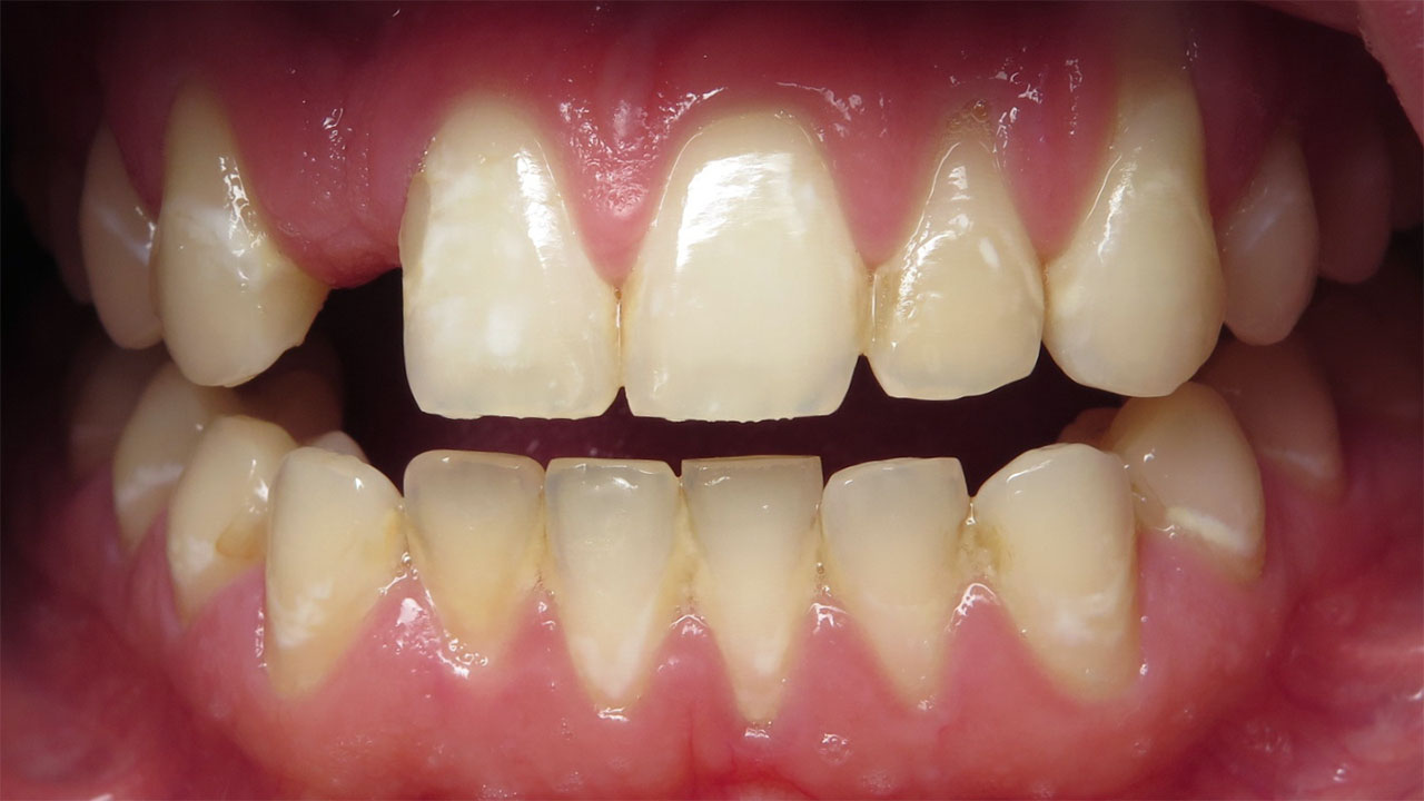 Cleft Lip Palate Missing Tooth Retracted Before Grandville Mi