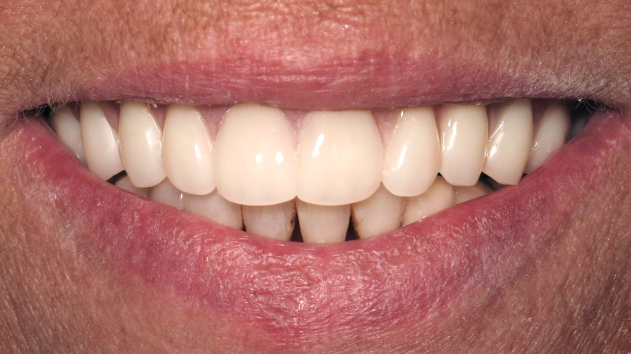 Complete Denture Partial Denture After Close Smile Grandville Mi