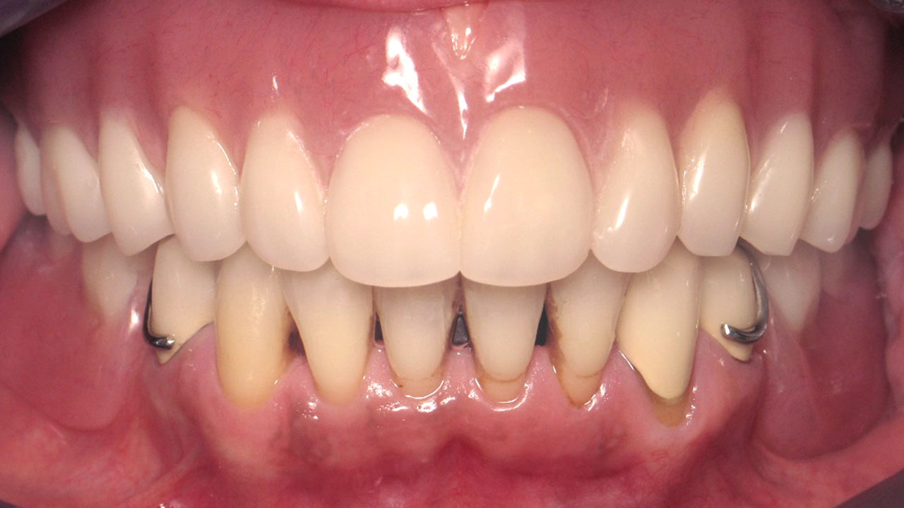Complete Denture Partial Denture After Retracted Grandville Mi