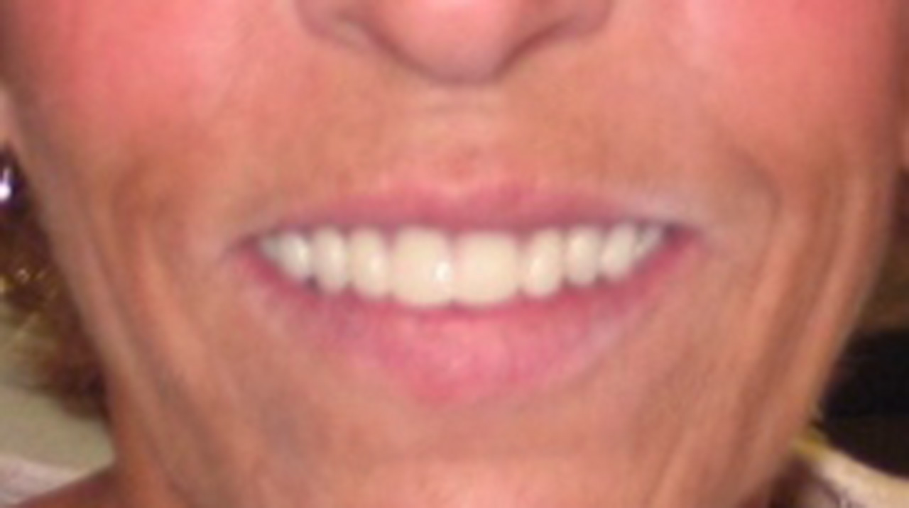 Complete Denture Partial Denture After Smile Grandville Mi