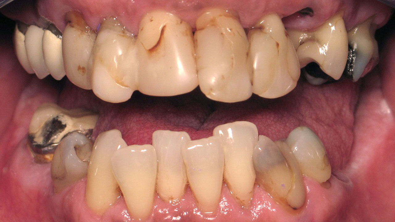 Complete Denture Partial Denture Before Retracted Grandville Mi