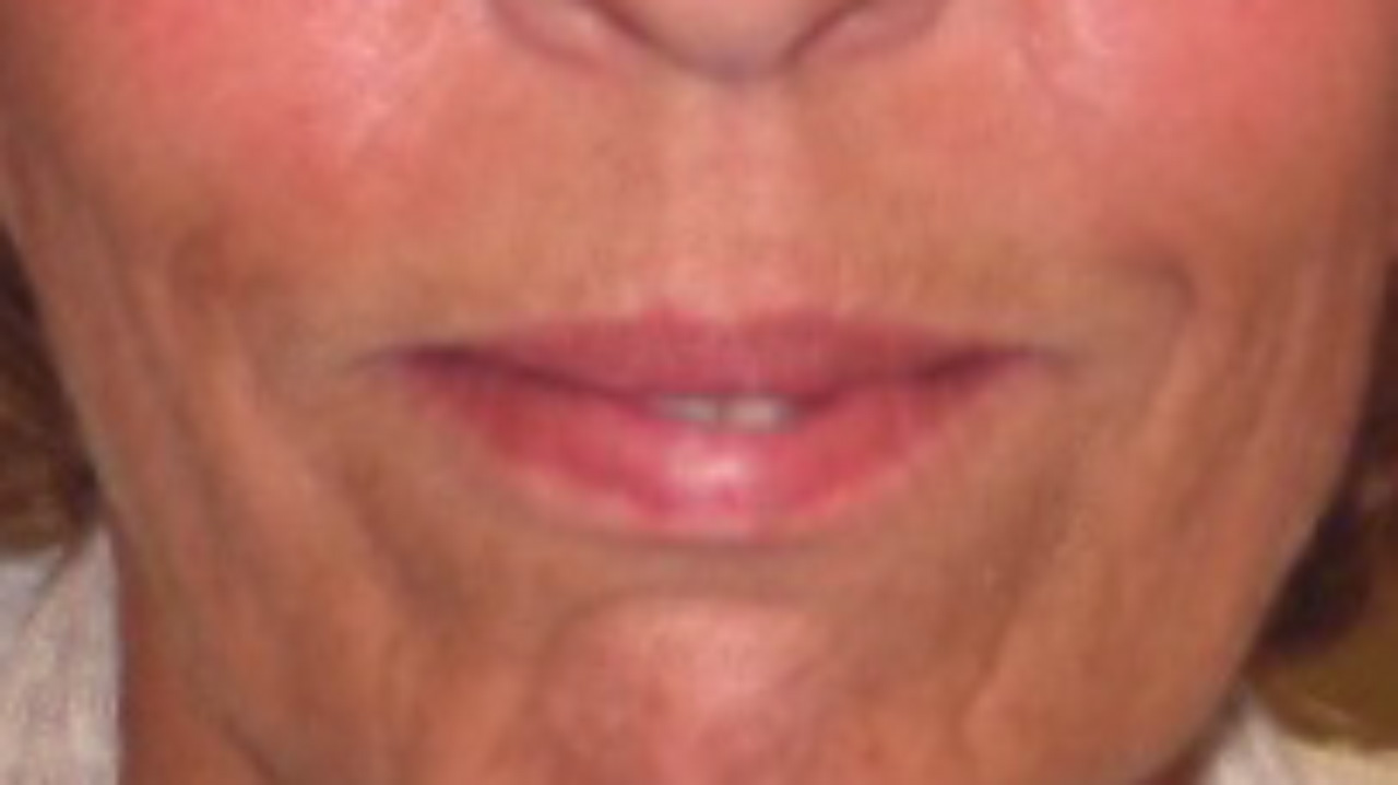 Complete Denture Partial Denture Before Smile Grandville Mi