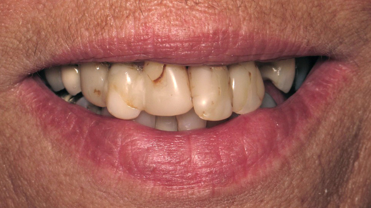 Complete Denture Partial Denture Before Upper Teeth Grandville Mi