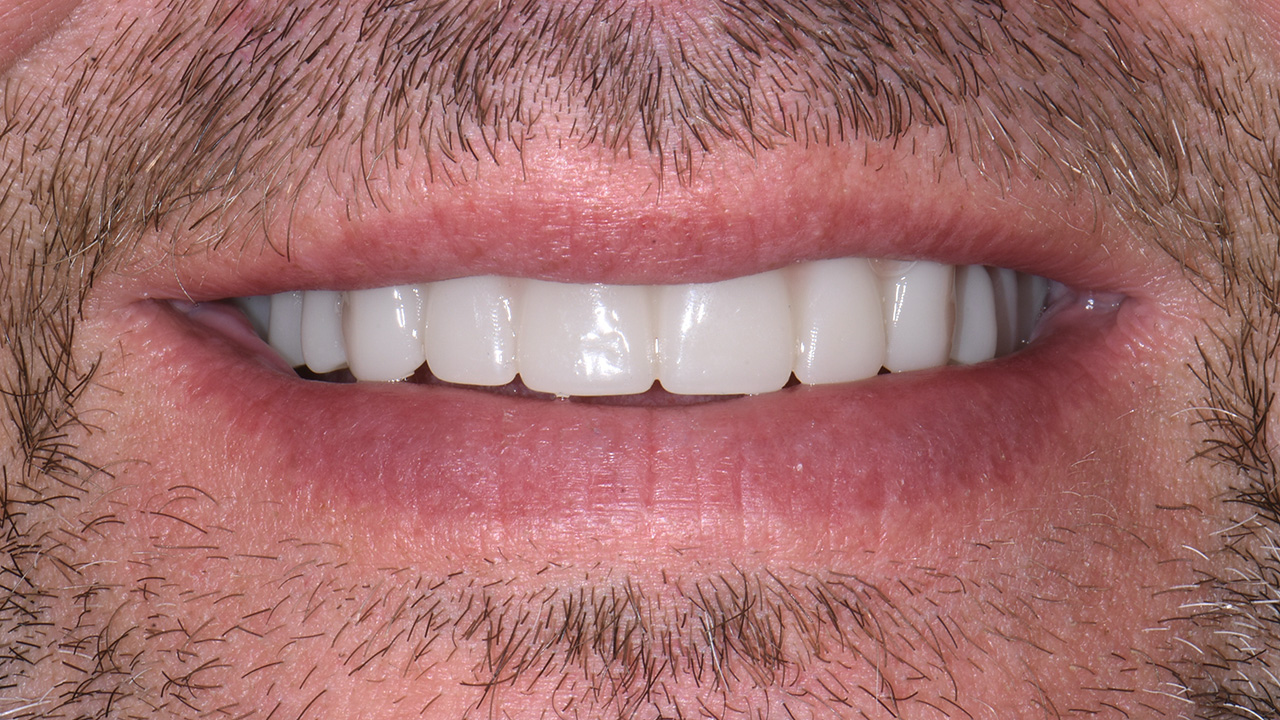 Complete Dentures After Close Smile Grandville Mi