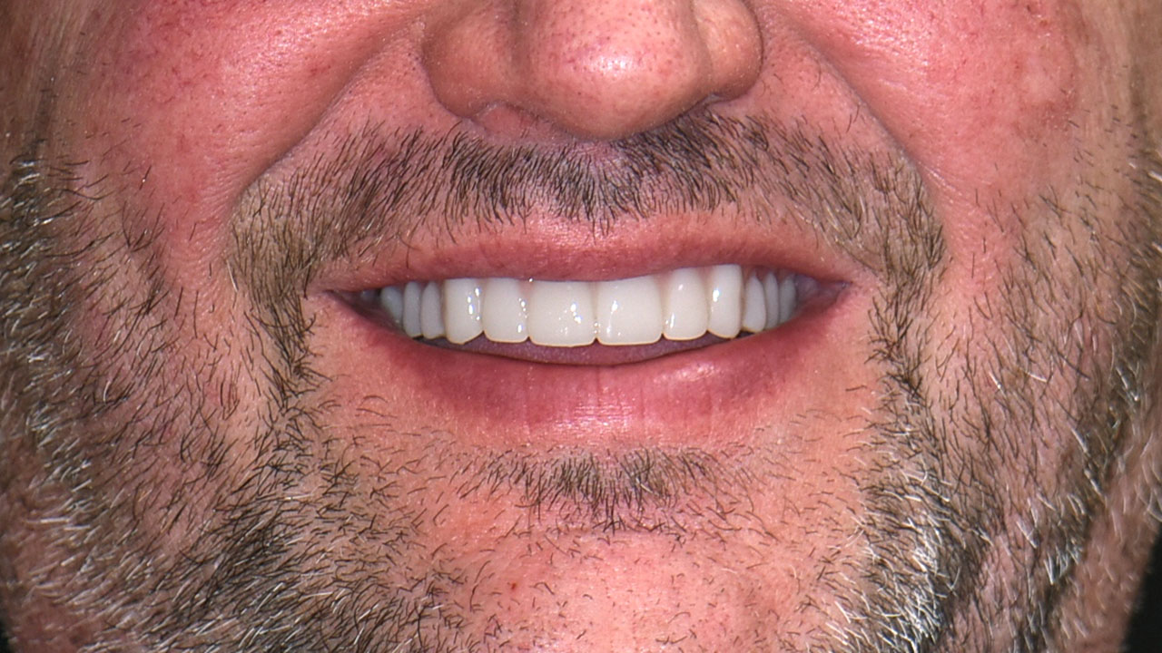 Complete Dentures After Smile Grandville Mi Complete Dentures After Smile Grandville Mi