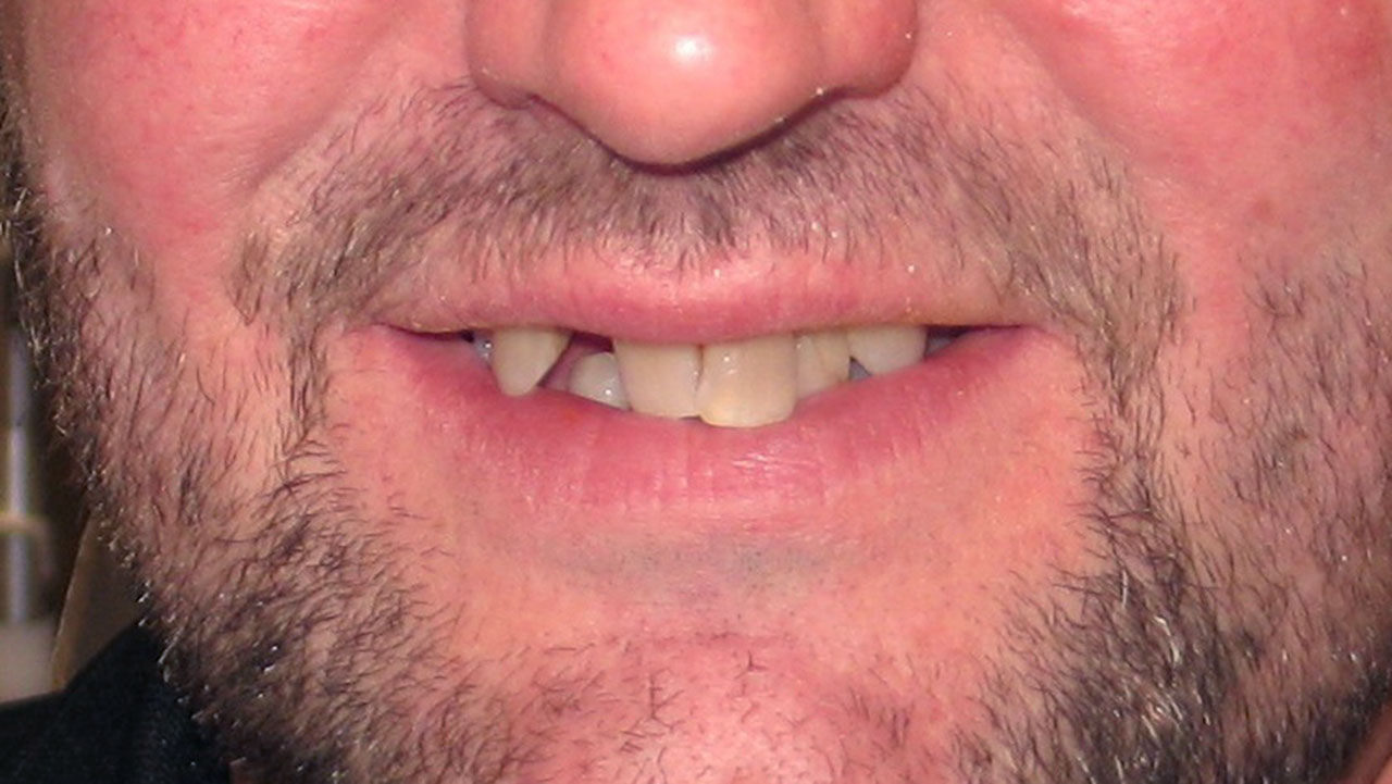 Complete Dentures Before Smile Grandville Mi