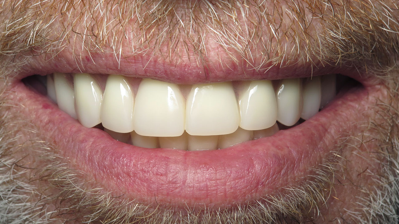 Complete Upper Denture Lower Partial After Close Smile Grandville Mi