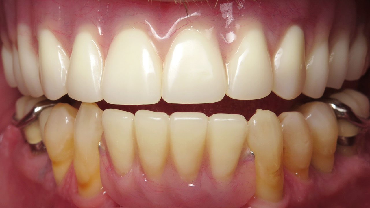 Complete Upper Denture Lower Partial After Retracted Grandville Mi