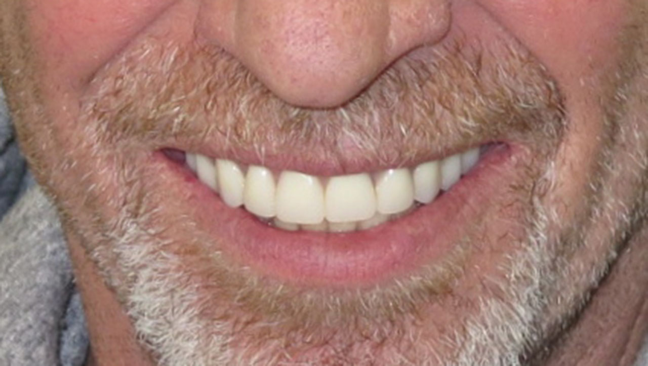 Complete Upper Denture Lower Partial After Smile Grandville Mi